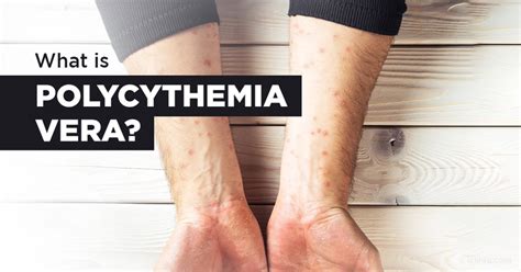 However, if the <b>polycythemia</b> is secondary to hypoxia, as in venous-to-arterial shunts or compromised lung and oxygenation, patients can also appear cyanotic. . Early stage polycythemia vera skin rash